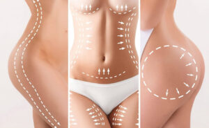 lipo-igg